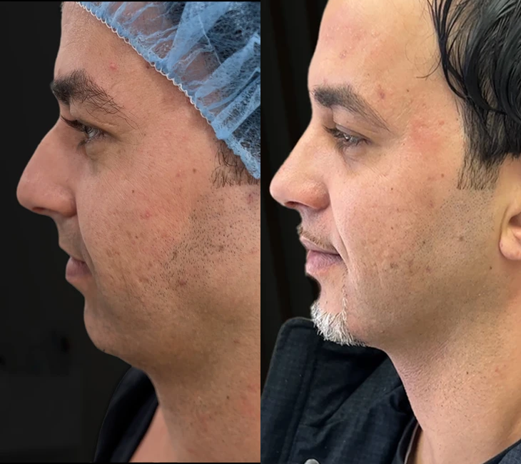 Rhinoplasty before and after photos by Noses and Necks NYC in New York, NY