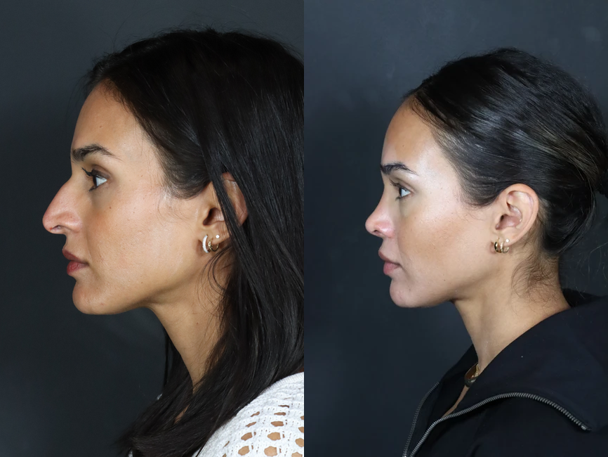 Rhinoplasty before and after photos by Noses and Necks NYC in New York, NY