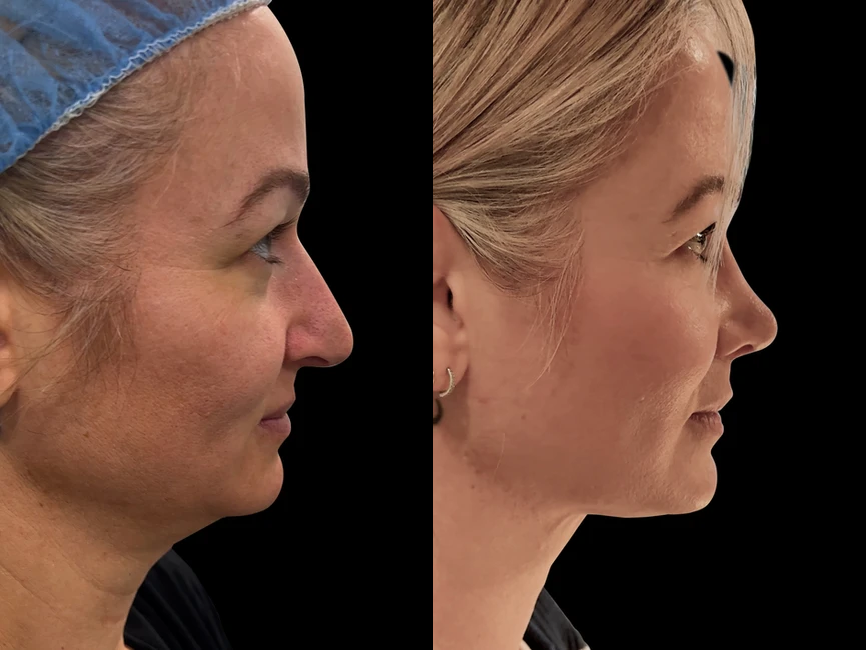 Rhinoplasty before and after photos by Noses and Necks NYC in New York, NY