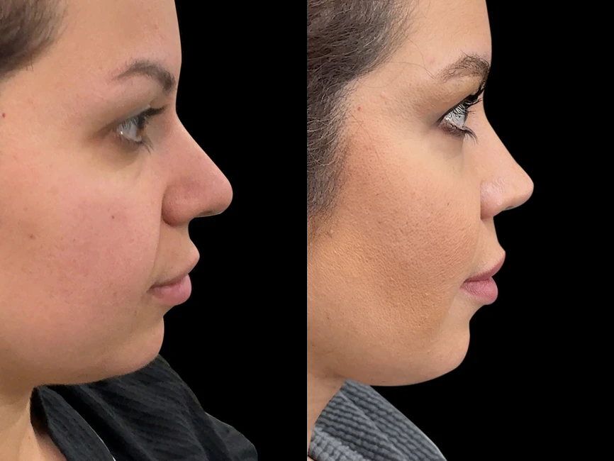 Rhinoplasty before and after photos by Noses and Necks NYC in New York, NY