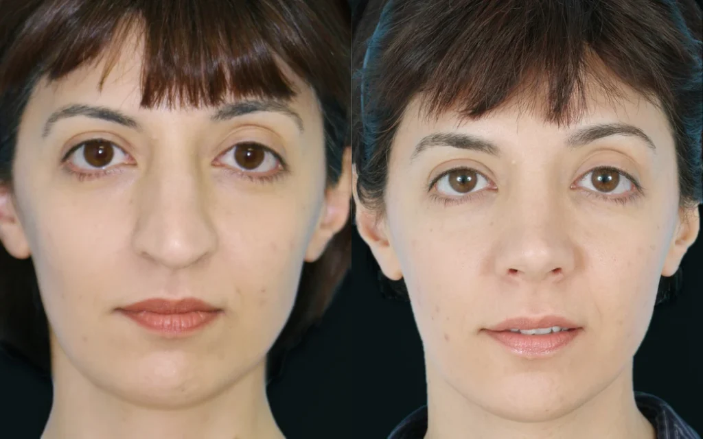 Rhinoplasty before and after photos by Noses and Necks NYC in New York, NY