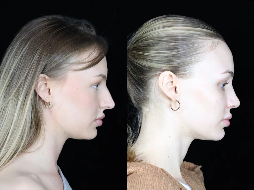 Rhinoplasty before and after photos by Noses and Necks NYC in New York, NY