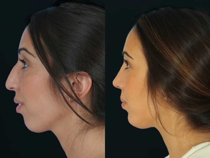 Rhinoplasty before and after photos by Noses and Necks NYC in New York, NY