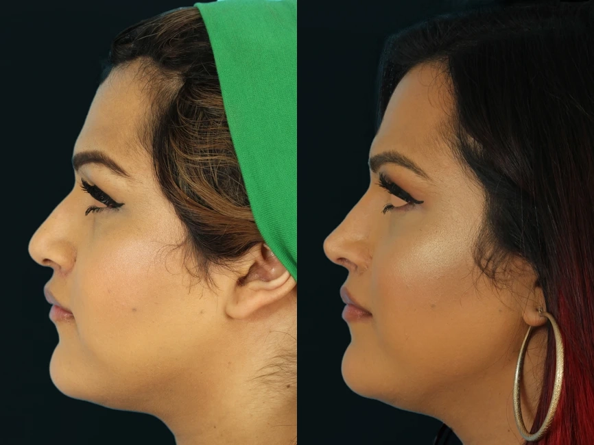 Rhinoplasty before and after photos by Noses and Necks NYC in New York, NY