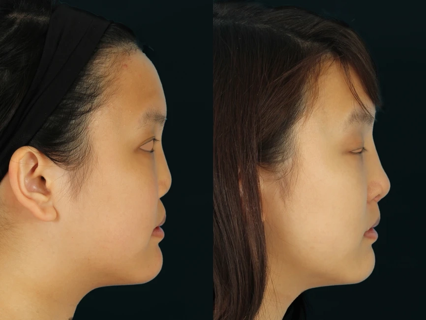 Rhinoplasty before and after photos by Noses and Necks NYC in New York, NY