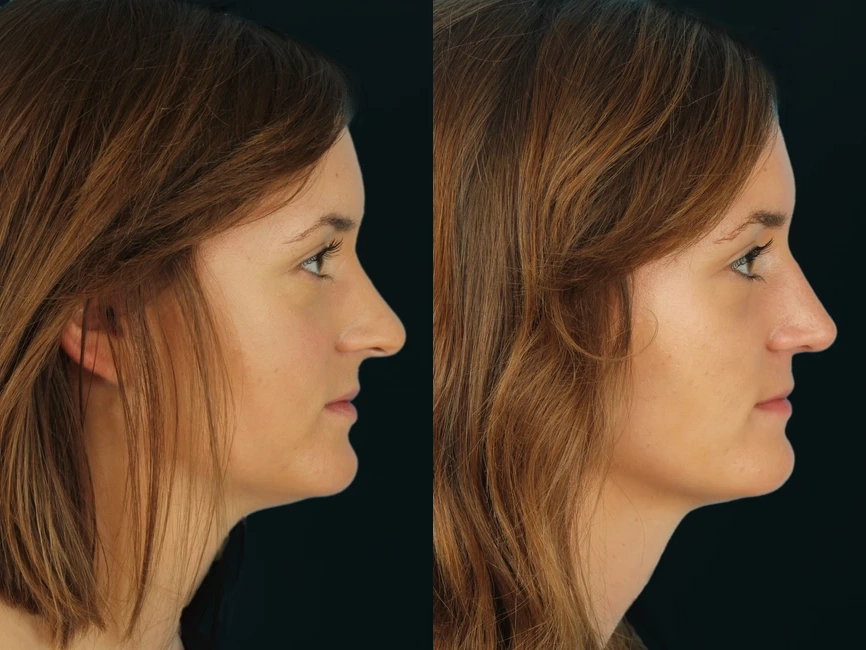 Rhinoplasty before and after photos by Noses and Necks NYC in New York, NY