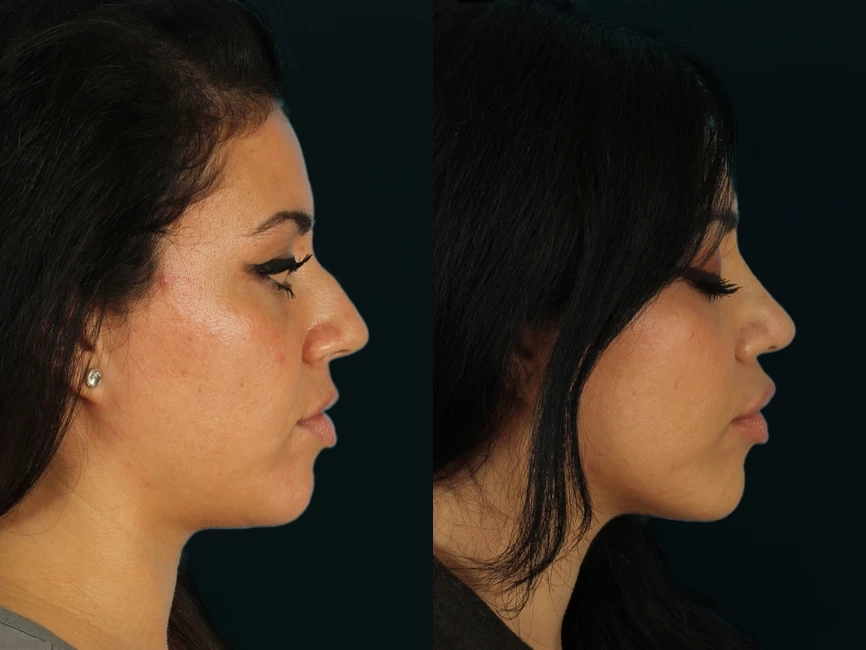 Rhinoplasty before and after photos by Noses and Necks NYC in New York, NY