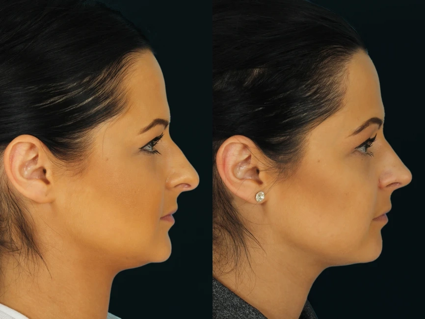 Rhinoplasty before and after photos by Noses and Necks NYC in New York, NY