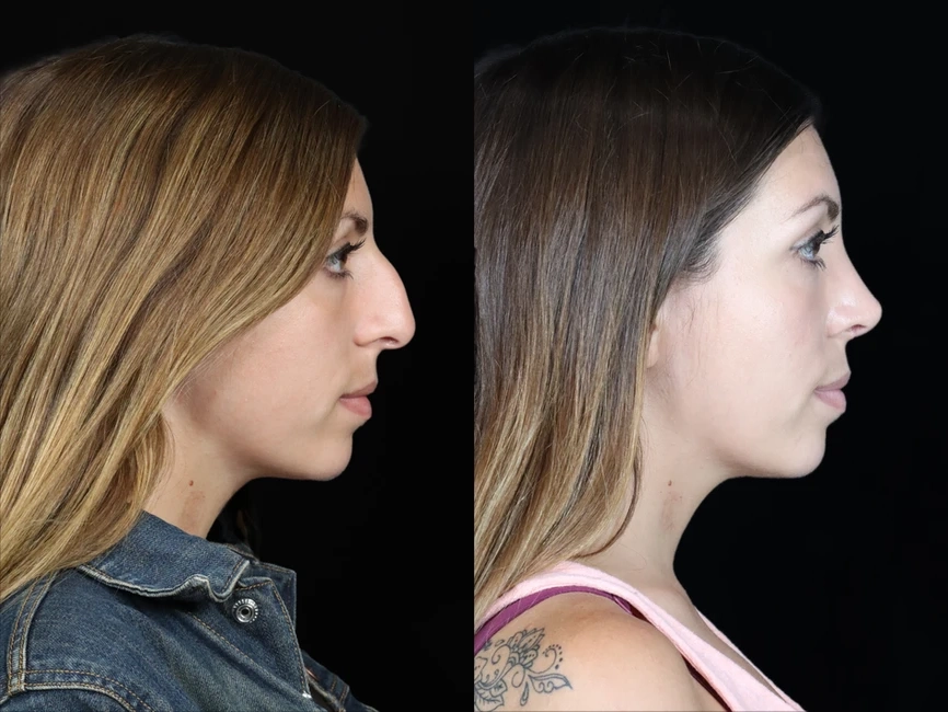 Rhinoplasty before and after photos by Noses and Necks NYC in New York, NY