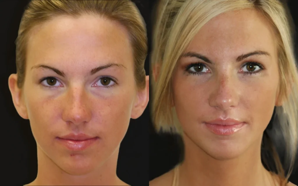 Rhinoplasty before and after photos by Noses and Necks NYC in New York, NY