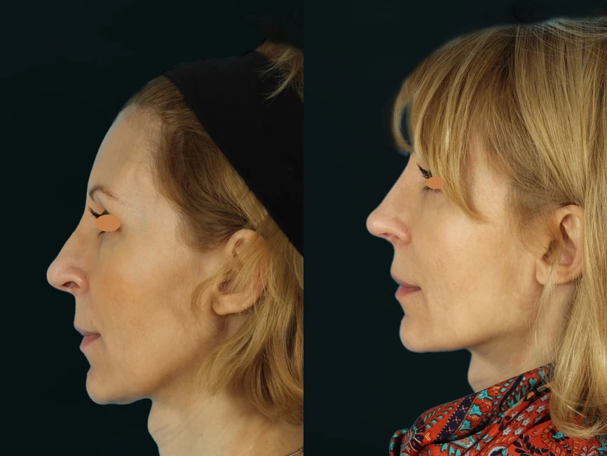 Rhinoplasty before and after photos by Noses and Necks NYC in New York, NY