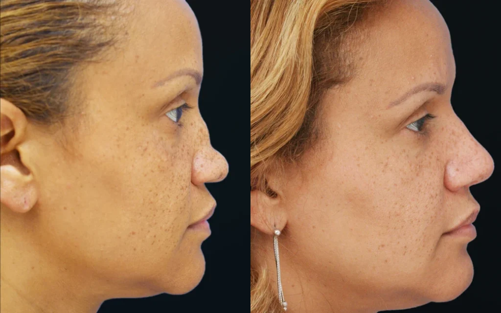 Rhinoplasty before and after photos by Noses and Necks NYC in New York, NY