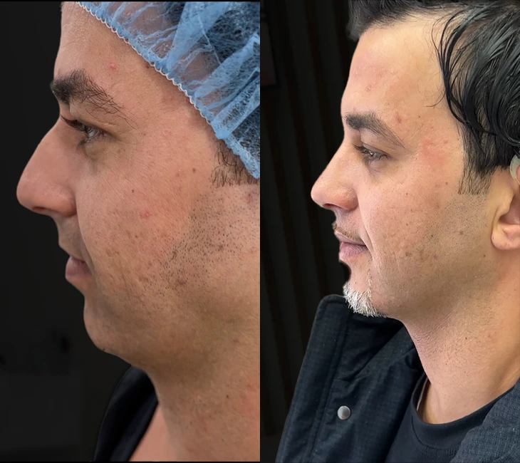 Rhinoplasty before and after photos by Noses and Necks NYC in New York, NY