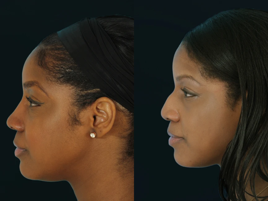 Rhinoplasty before and after photos by Noses and Necks NYC in New York, NY