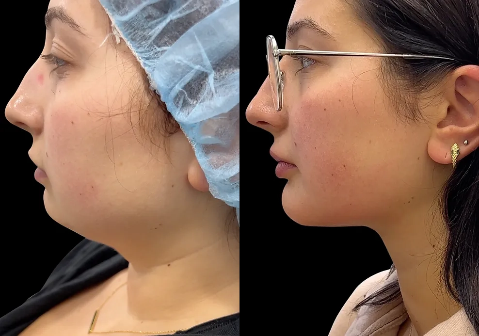 Aging Face before and after photos by Noses and Necks NYC in New York, NY