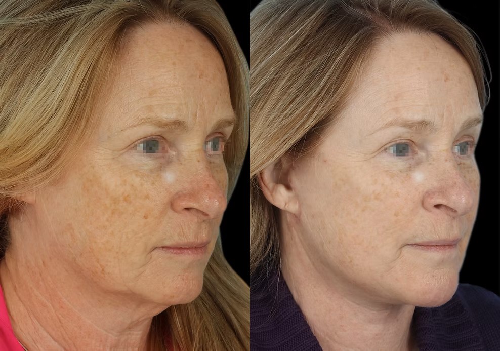 Aging Face before and after photos by Noses and Necks NYC in New York, NY