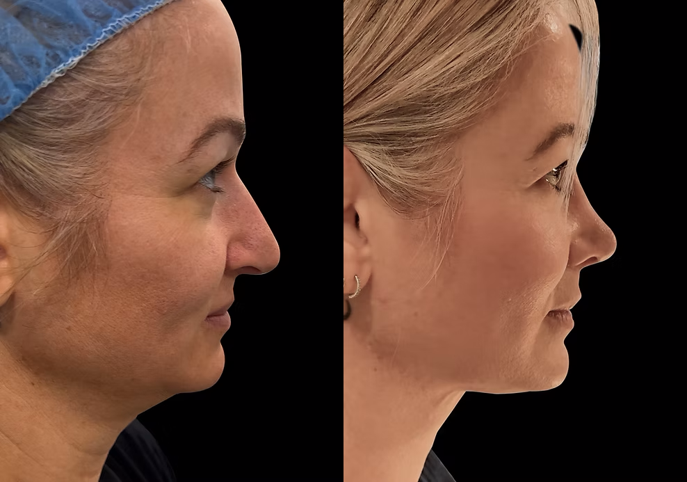 Aging Face before and after photos by Noses and Necks NYC in New York, NY