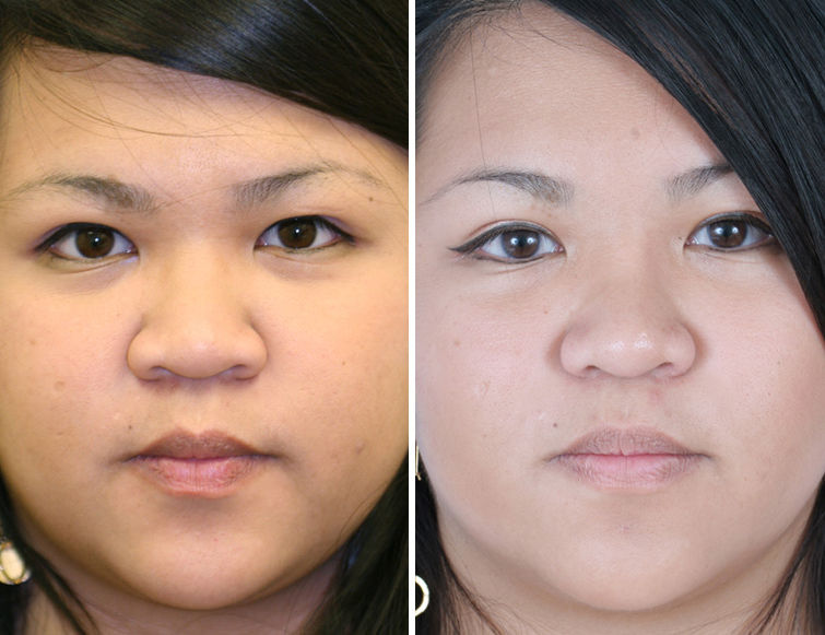 asian rhinoplasty pictures