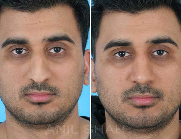 indian rhinoplasty pictures