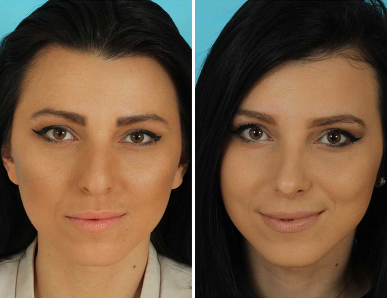 middle eastern rhinoplasty pictures